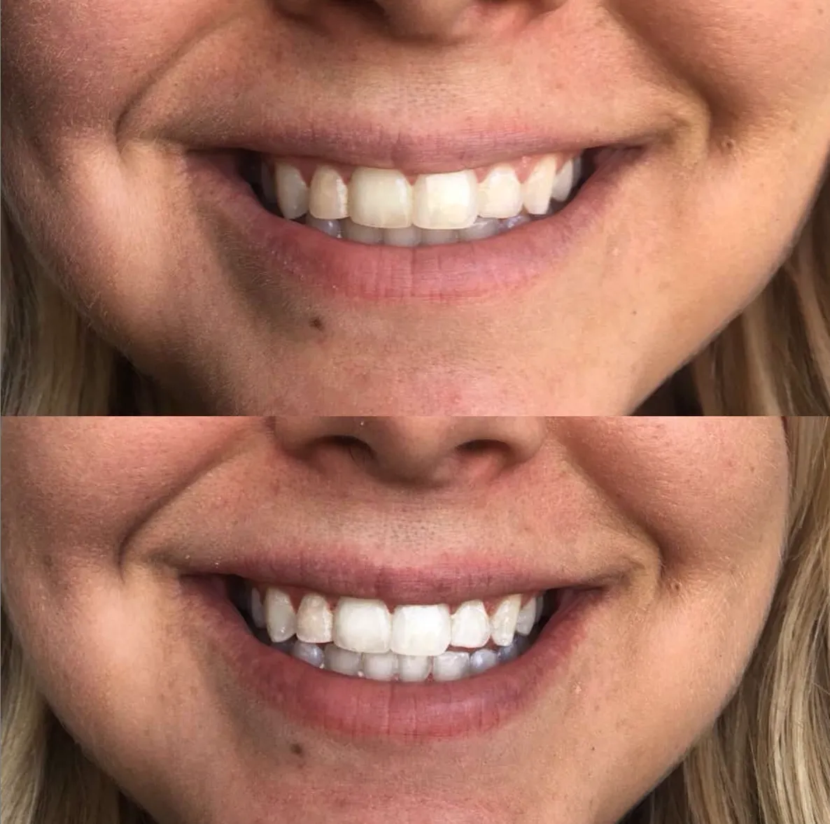 19858   LED Dual Whitening System