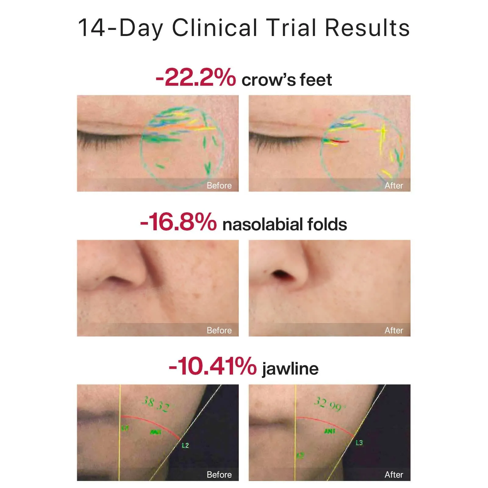 AMIRO R1 PRO RF Skin Tightening Device