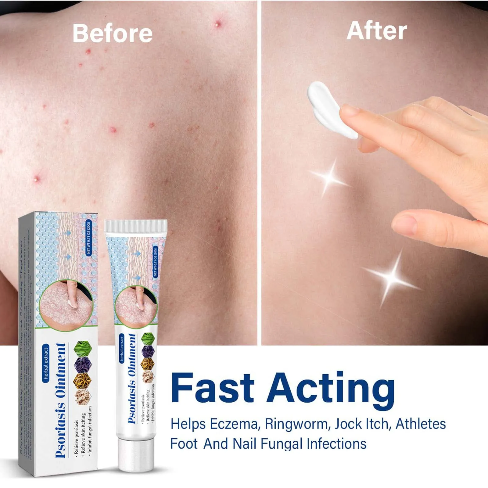 Athletes Foot Treatment Antifungal-Cream Anti-Itch Cream with Gentler and Safer Herbal Ingredients Quickly Relives Itching for Face & Body for Ringworm