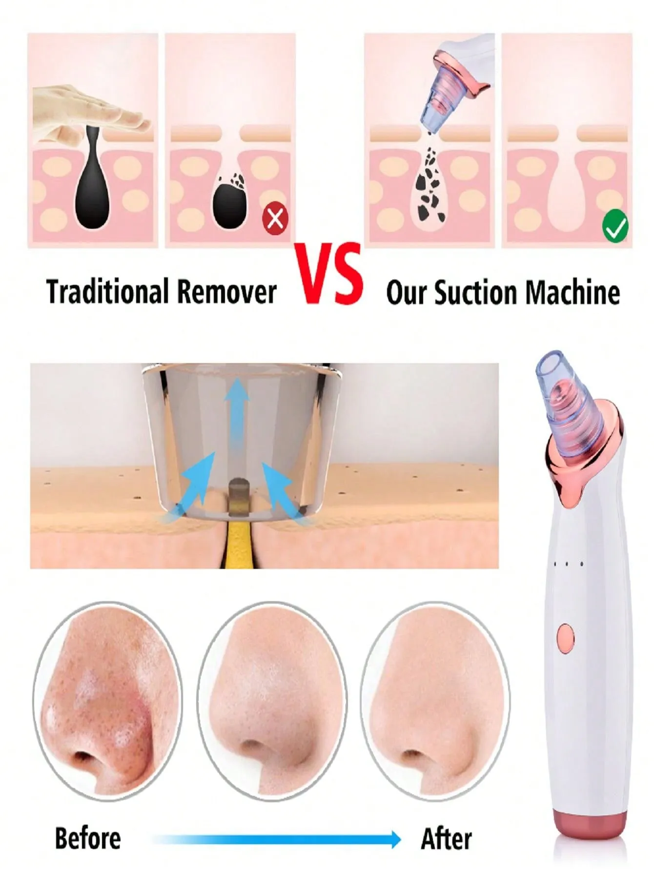 Blackhead Remover Pimple Acne Removal Blackhead Vacuum Tool Skin Care