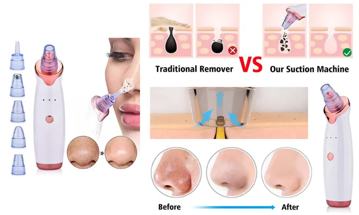 Blackhead Remover