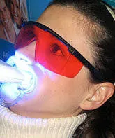 Blue Gel Gum Protector for Professional Teeth Whitening