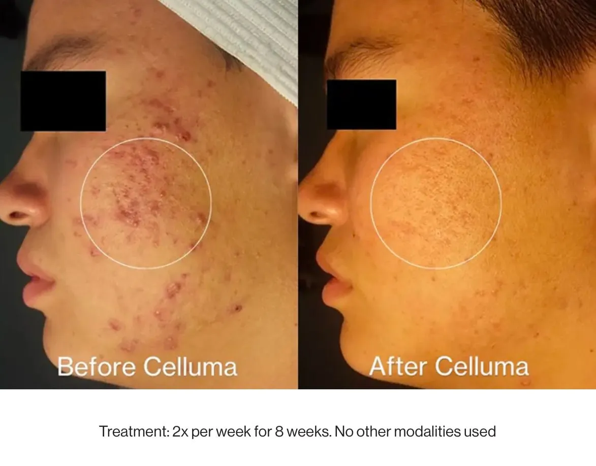 Celluma Pro