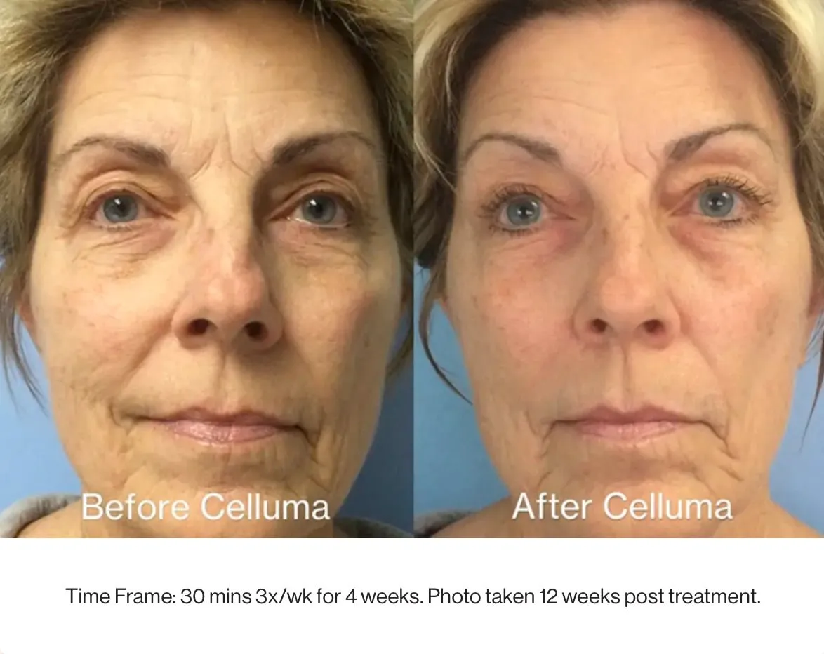 Celluma Pro