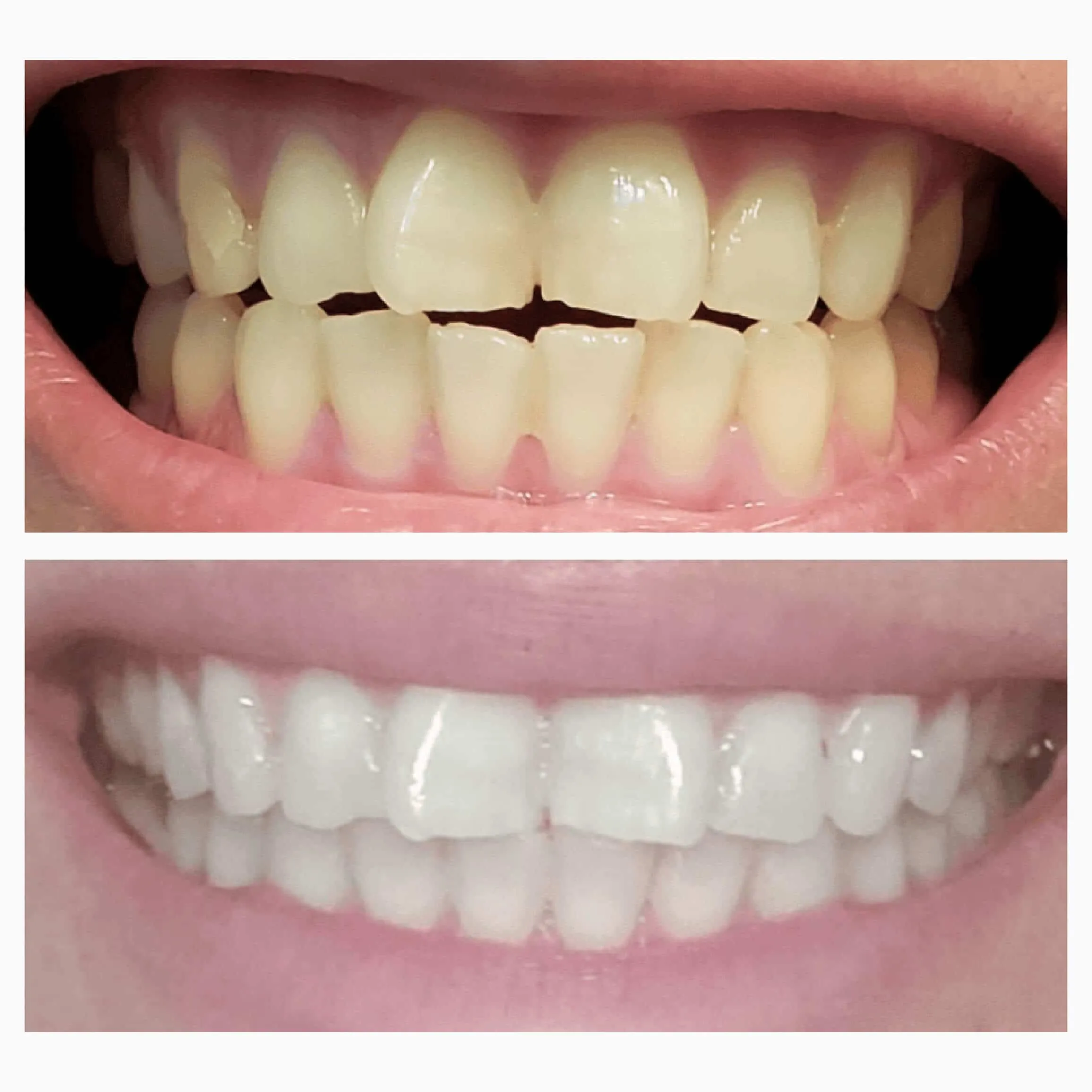 Daily Toothpaste Whitening Booster Gel - Add to Toothpaste for Instant Boost