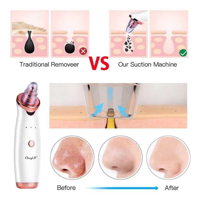Electric Vacuum Suction Cleaner Face Cleaning Blackhead Removal Black Spot Facial Cleansing Machine Skin Scrubber Pore Cleanser for Beauty & Health