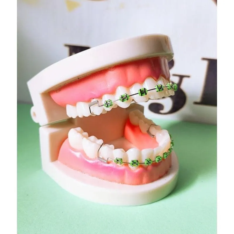 Fashion Braces For Upper & Lower Teeth