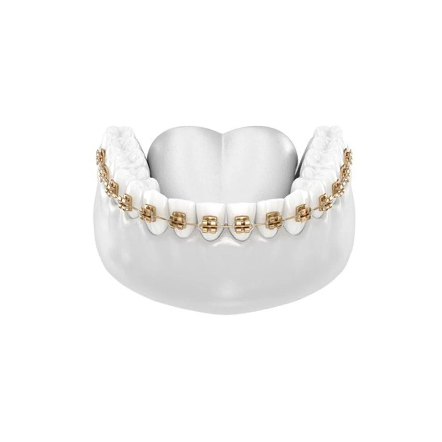 Fashion Braces For Upper & Lower Teeth