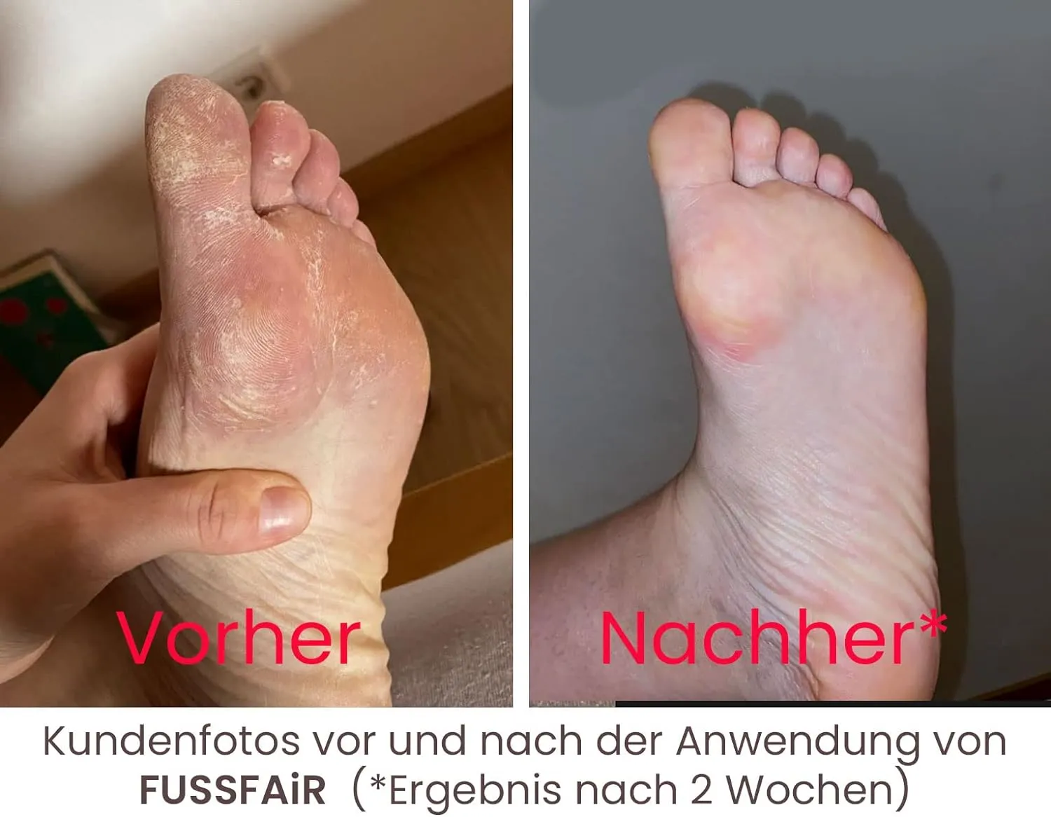 FUSSFAIR Callus Remover Balm - Natural Callus Elimination Cream | Non-Greasy Formula - 30ml