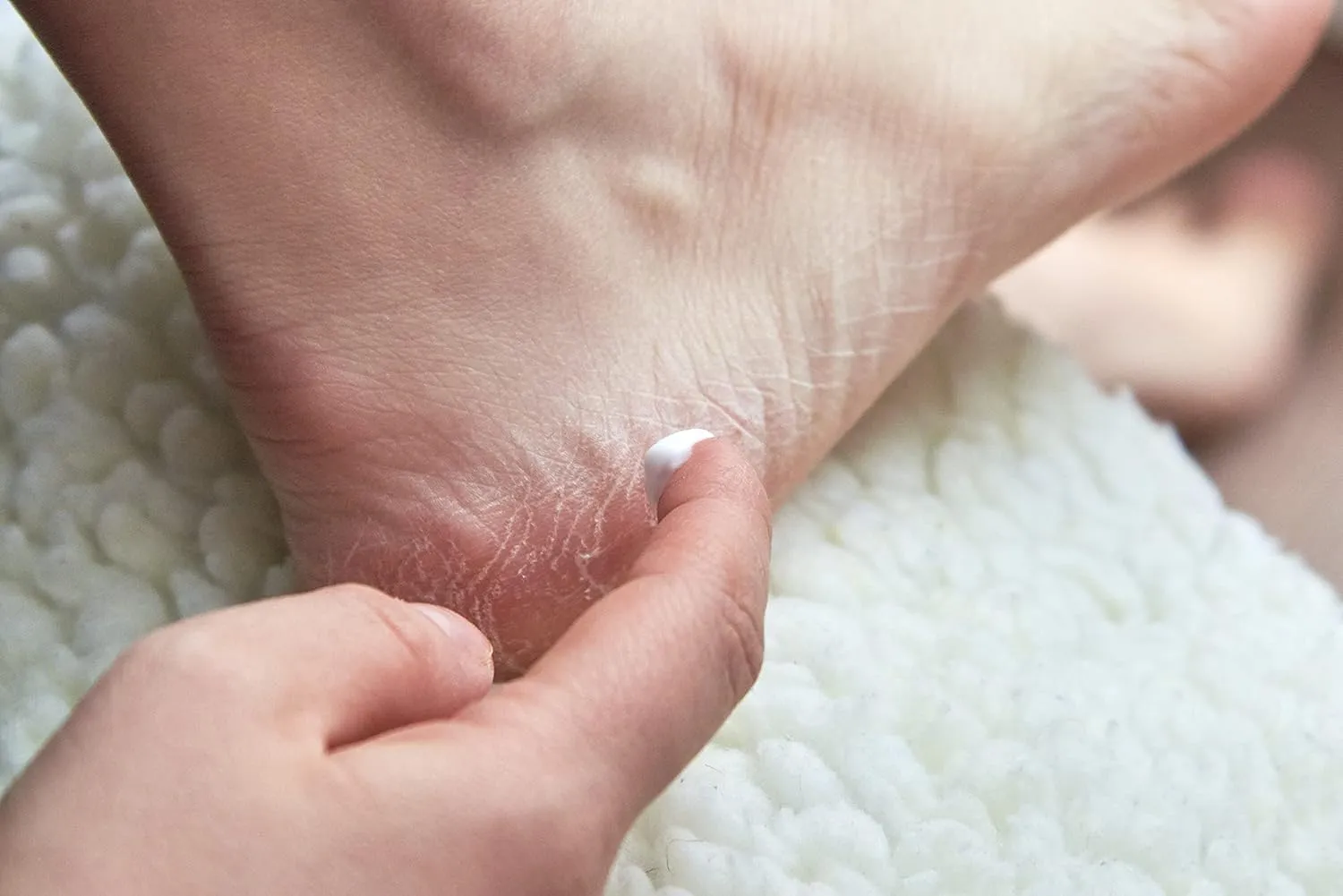 FUSSFAIR Callus Remover Balm - Natural Callus Elimination Cream | Non-Greasy Formula - 30ml