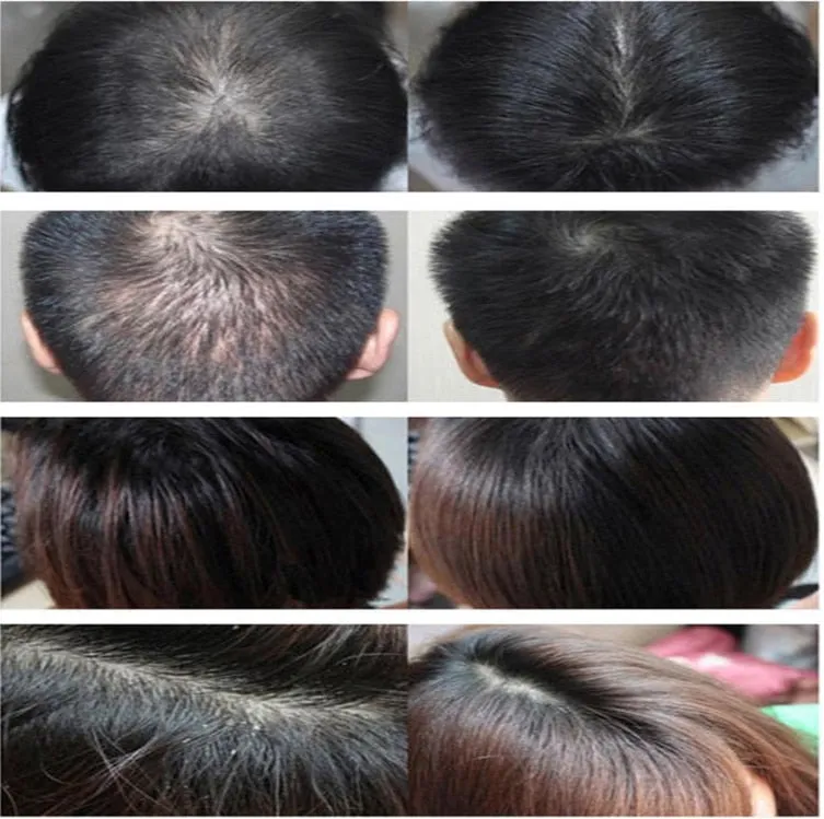 Hair Regrowth Beard Growth Cap COZING Hair Loss Treatment