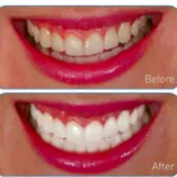 Instant Teeth Whitening Pen
