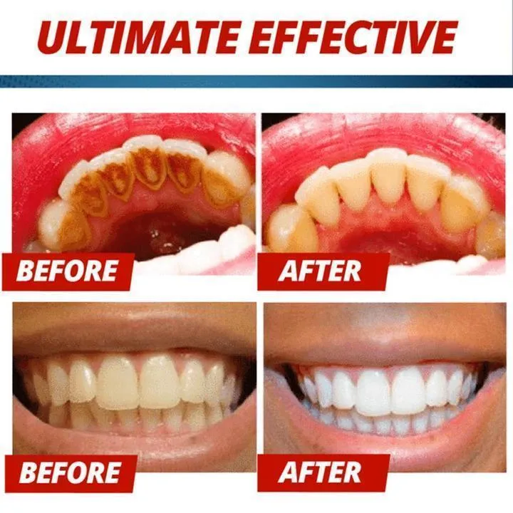 Intensive stain removal whitening toothpaste