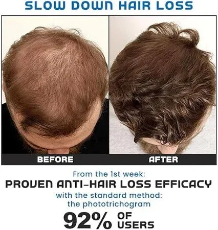 Minoxi Roll-On Hair Treatment Hair Growth Serum