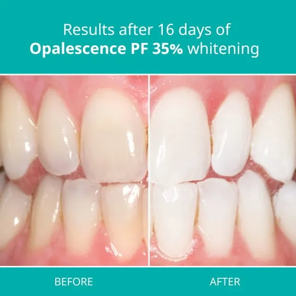 Opalescence Teeth Whitening Gel Syringes 35% Mint - Teeth Whitening, Oral Health - 4 Syringes