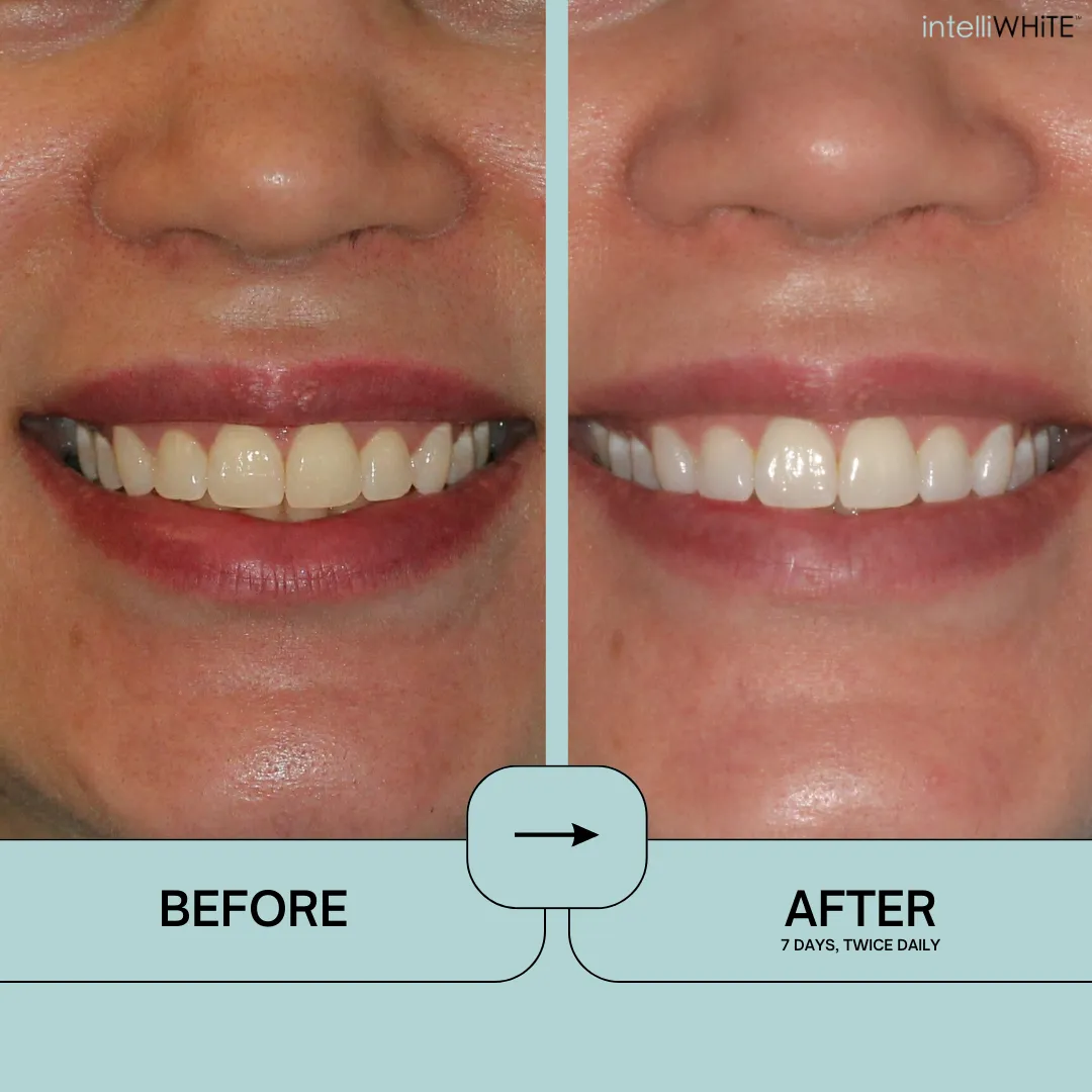 Prostrips Teeth Whitening Strips