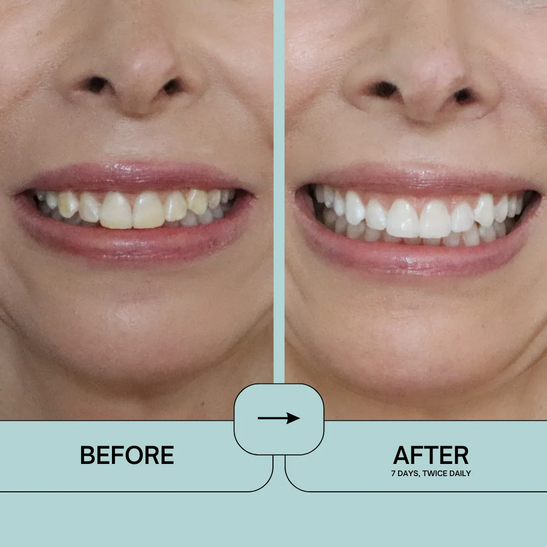 Prostrips Teeth Whitening Strips