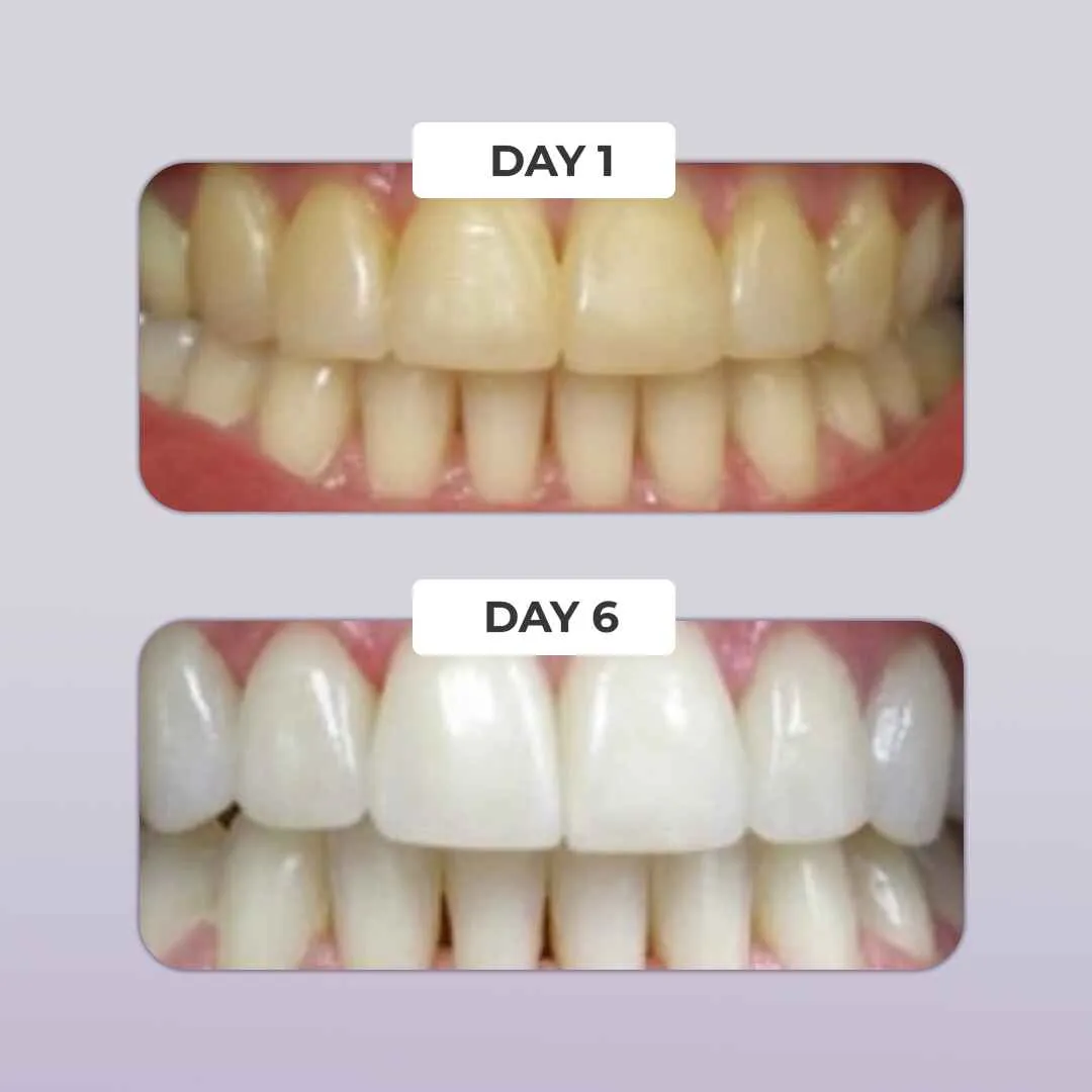 PUURSMILE TEETH WHITENING KIT - 50% OFF SPRING SALE
