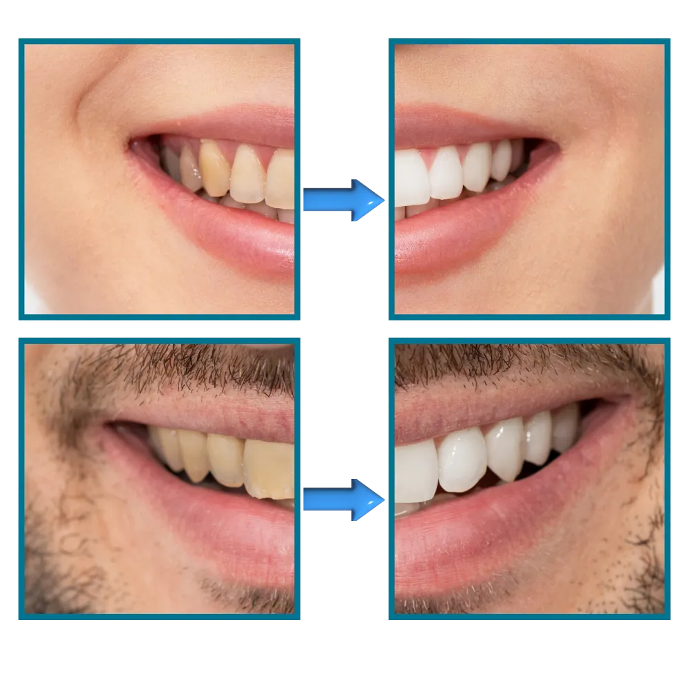 Quick Stain Removal Teeth Whitening