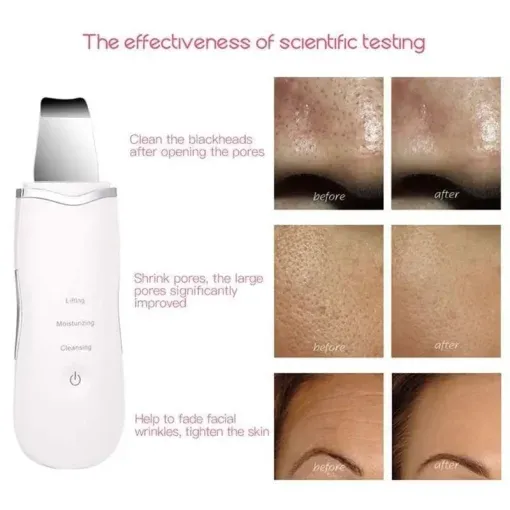 SmartMart® Ultrasonic Facial Skin Scrubber