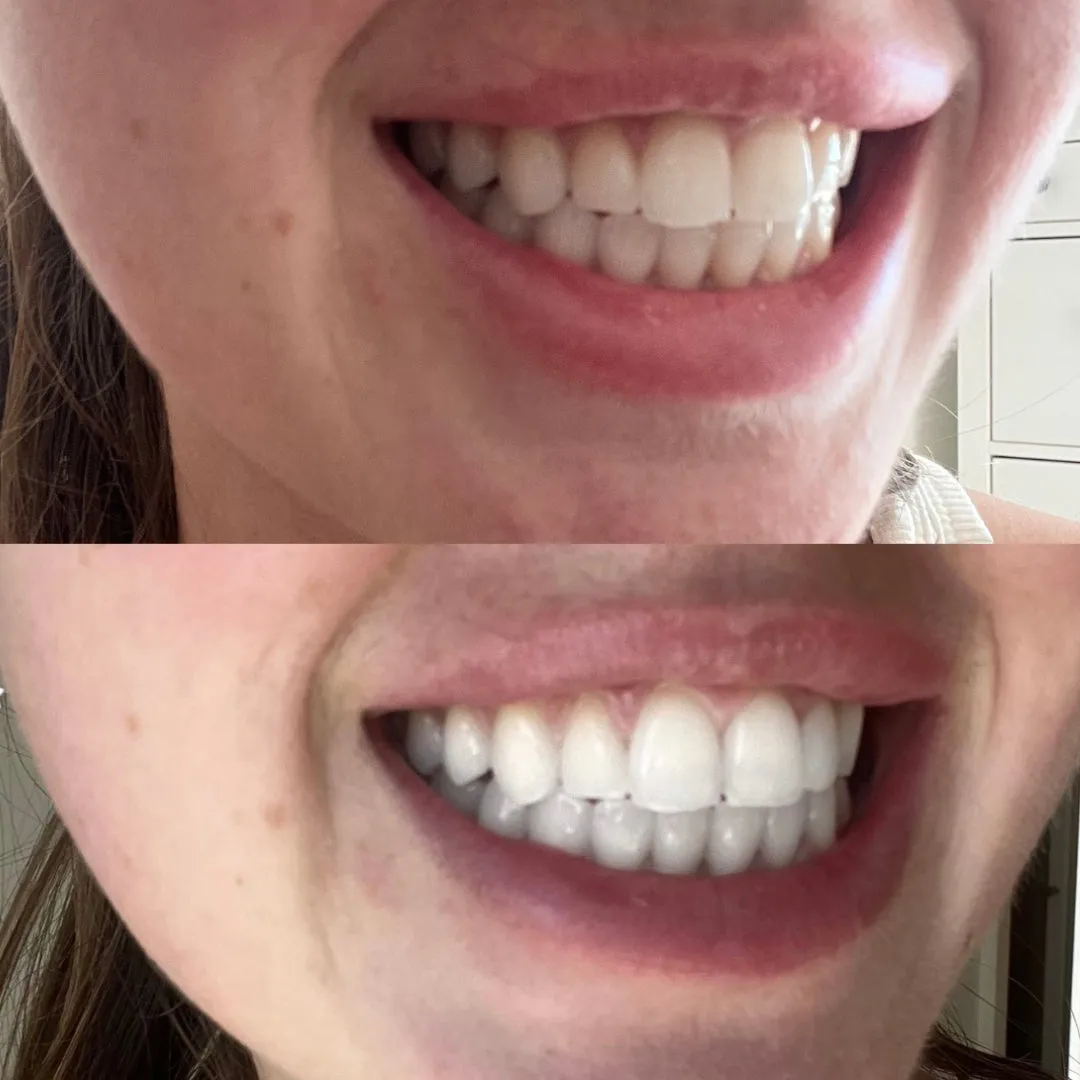 Teeth Whitening Kit Duo Bundle