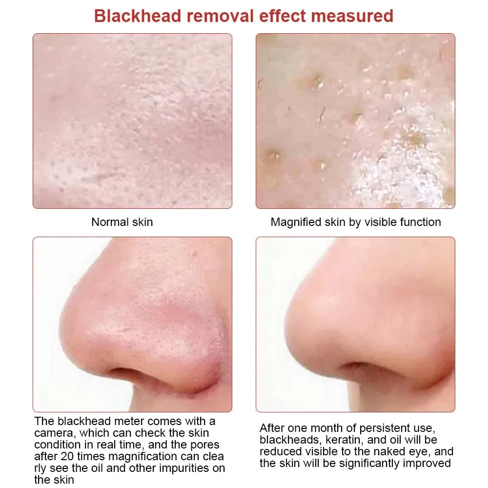 WiFi Camera Blackhead Remover Vacuum with LED Display
